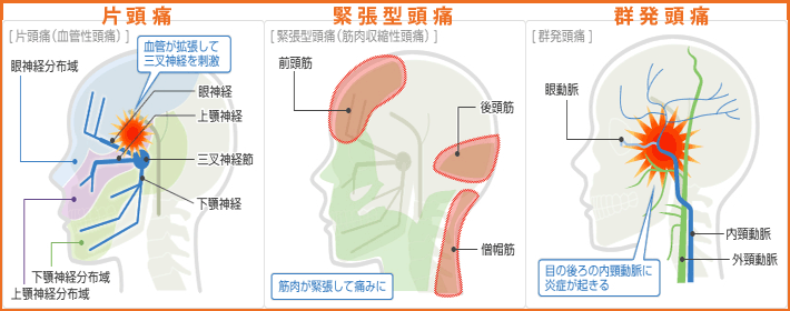 慢性頭痛の３種類
